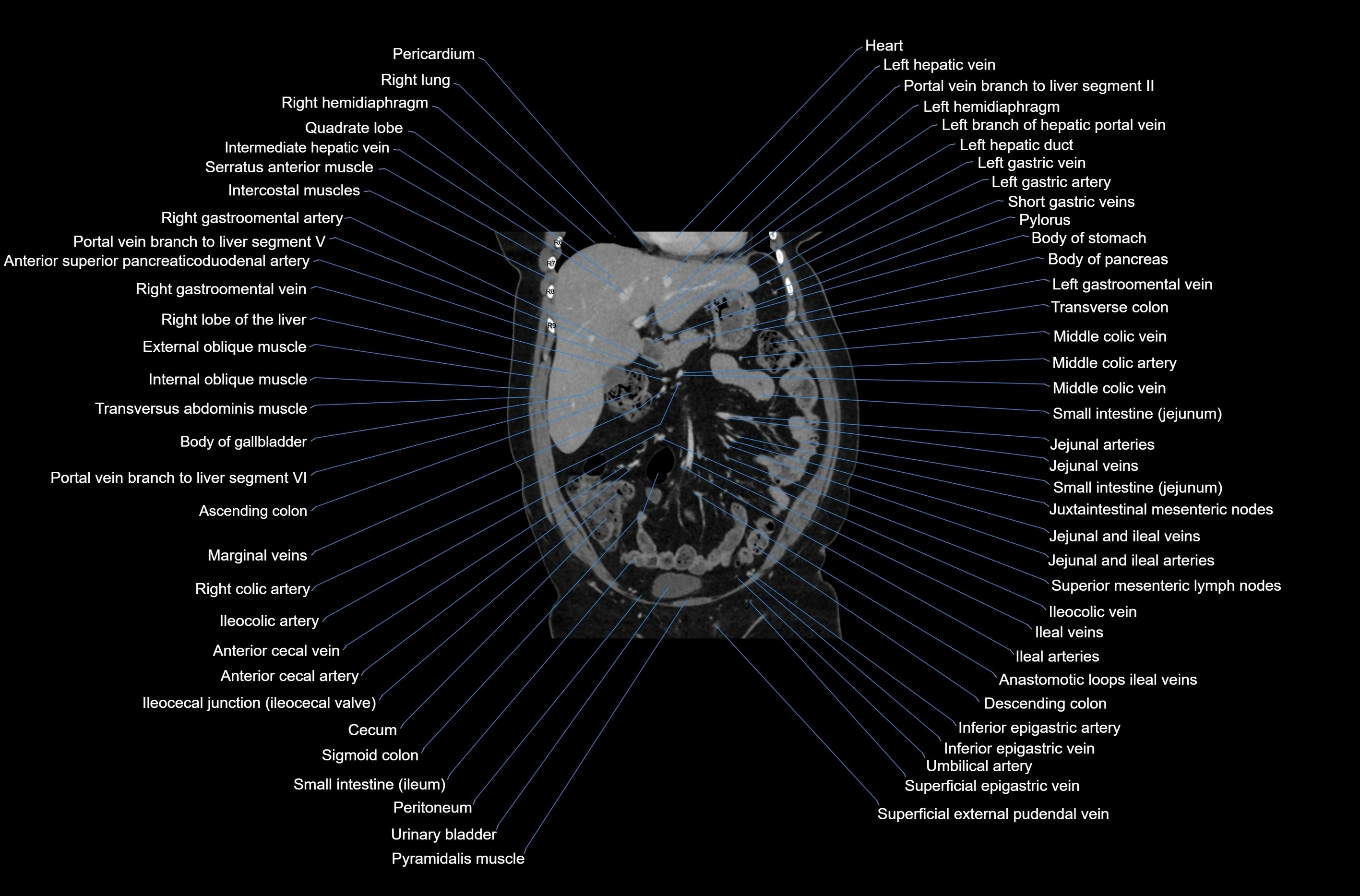 CT abdomen coronal cross sectional anatomy labelled radiology image-00030.webp